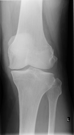 Vor Schlittenprothese Verschleiß des innenseitigen Kniegelenkanteils
