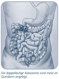 Die doppelläufige Kolostomie