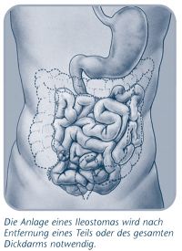 Ileostoma (Dünndarmausgang)